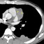 Axial contrast enhanced CT at the level of left ventricular appendage demonstrates a 5cm anterior mediastinal mass. The mass <strong>enhances heterogeneously(arrows)</strong>, abuts and is inseprable from the left ventricular appendage, with no fat plane separating between them. There is a pleural nodule associated with a tiny effusion. There is no lymphadenopathy. Because of the pleural nodule, this is most suggestive of a stage IVa thymoma, which was confirmed at surgery. However, despite the tumor abutting the left atrial appendage, no pericardial invasion was seen at surgery.